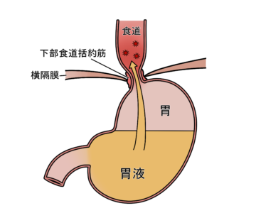 逆流性食道炎のアイキャッチ画像