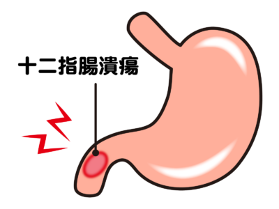 胃・十二指腸潰瘍のアイキャッチ画像