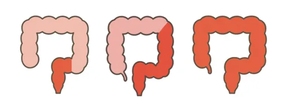 直腸炎型 左側大腸炎型 全大腸炎型