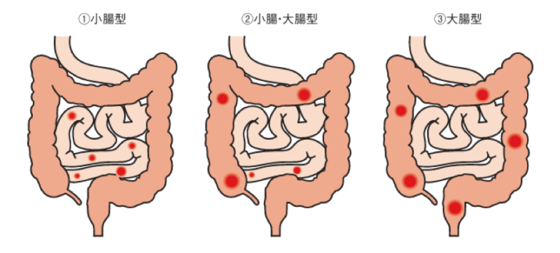 クローン病の分類