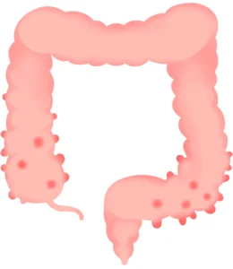 大腸憩室とはのアイキャッチ画像