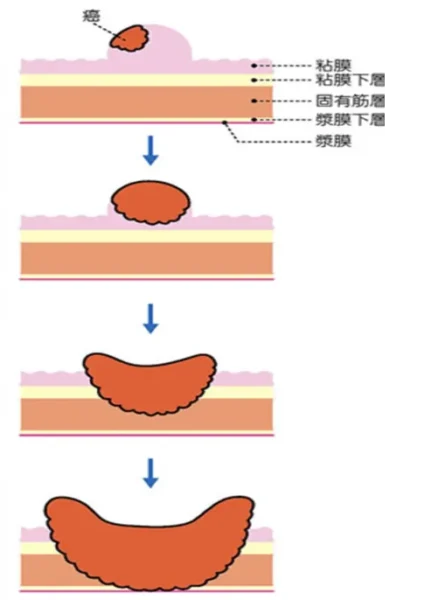 壁深達度(がんの浸潤)