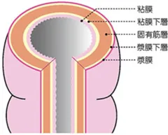壁深達度(がんの浸潤)